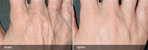 Rajeunissement des mains au laser